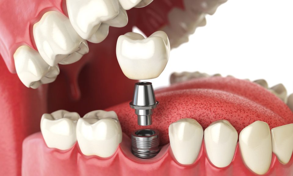 Understanding All-on-4 Dental Implants Insights from Expert Dentists